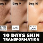 ACNE SCARS & OPEN PORES REMEDY