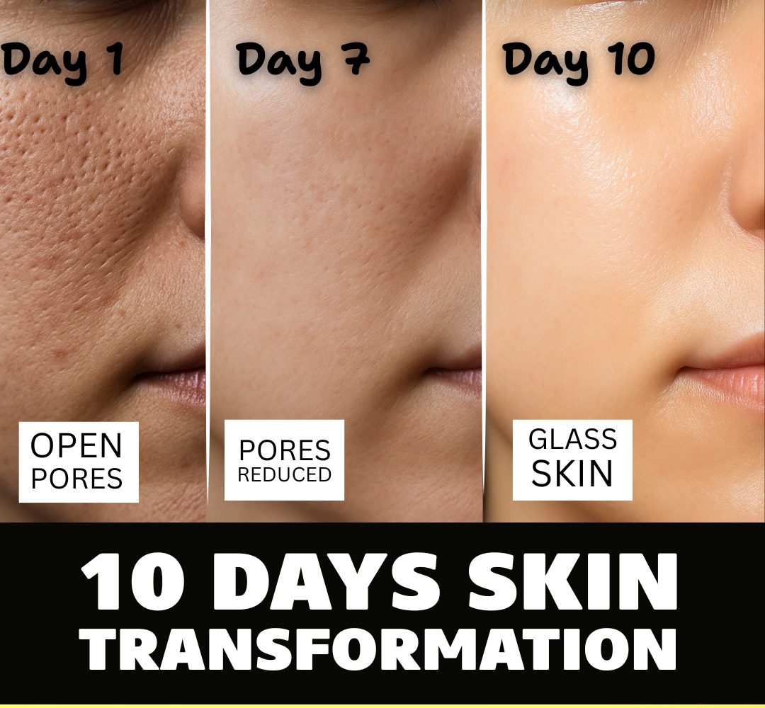 ACNE SCARS & OPEN PORES REMEDY